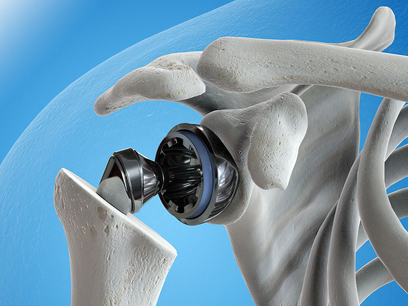 thay-khop-vai-nhan-tao-cho-benh-nhan-nguoi-my-thoai-hoa-khop-vai