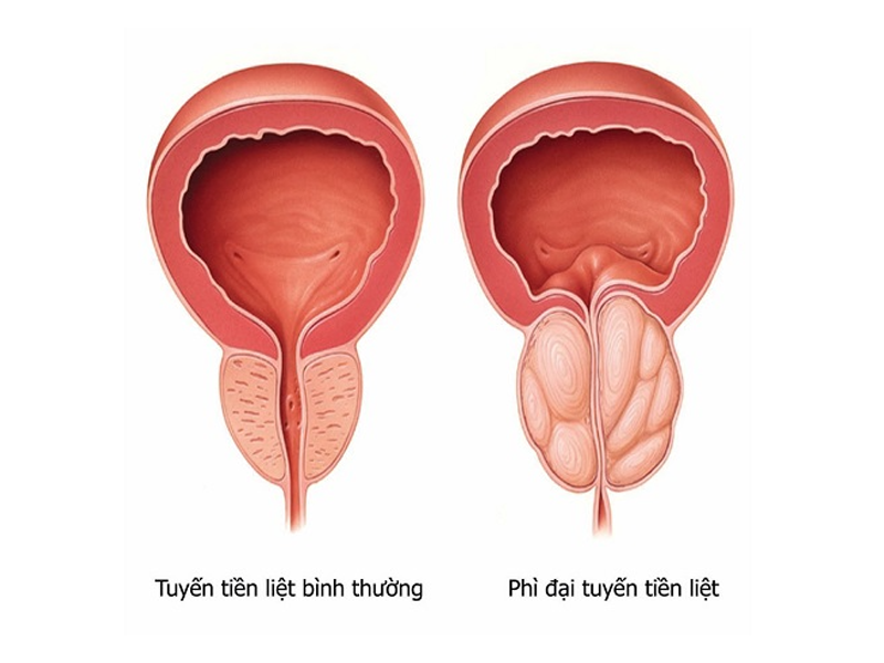 tuyen-tien-liet-to-gap-5-lan-binh-thuong