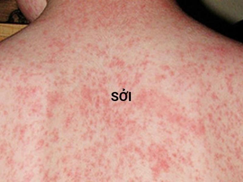 ban-soi-dau-hieu-nhan-biet-cach-phong-tranh-va-dieu-tri-hieu-qua-cho-moi-lua-tuoi